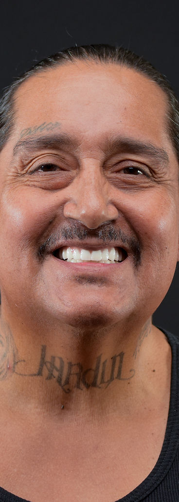 Glo patient smiling after replacing dentures with All-on-6 implants