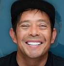 All-on-6 after photo Douglas, double-arch implant restoration, Orange County