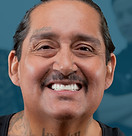 All-on-4 after photo Henry, double-arch implant restoration, Orange County