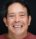 All-on-6 before photo Douglas, double-arch implant restoration, Orange County