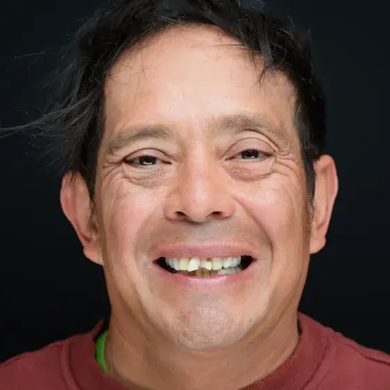 Douglas before All-on-4 treatment