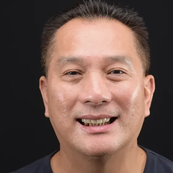 Kim before All-on-4 treatment
