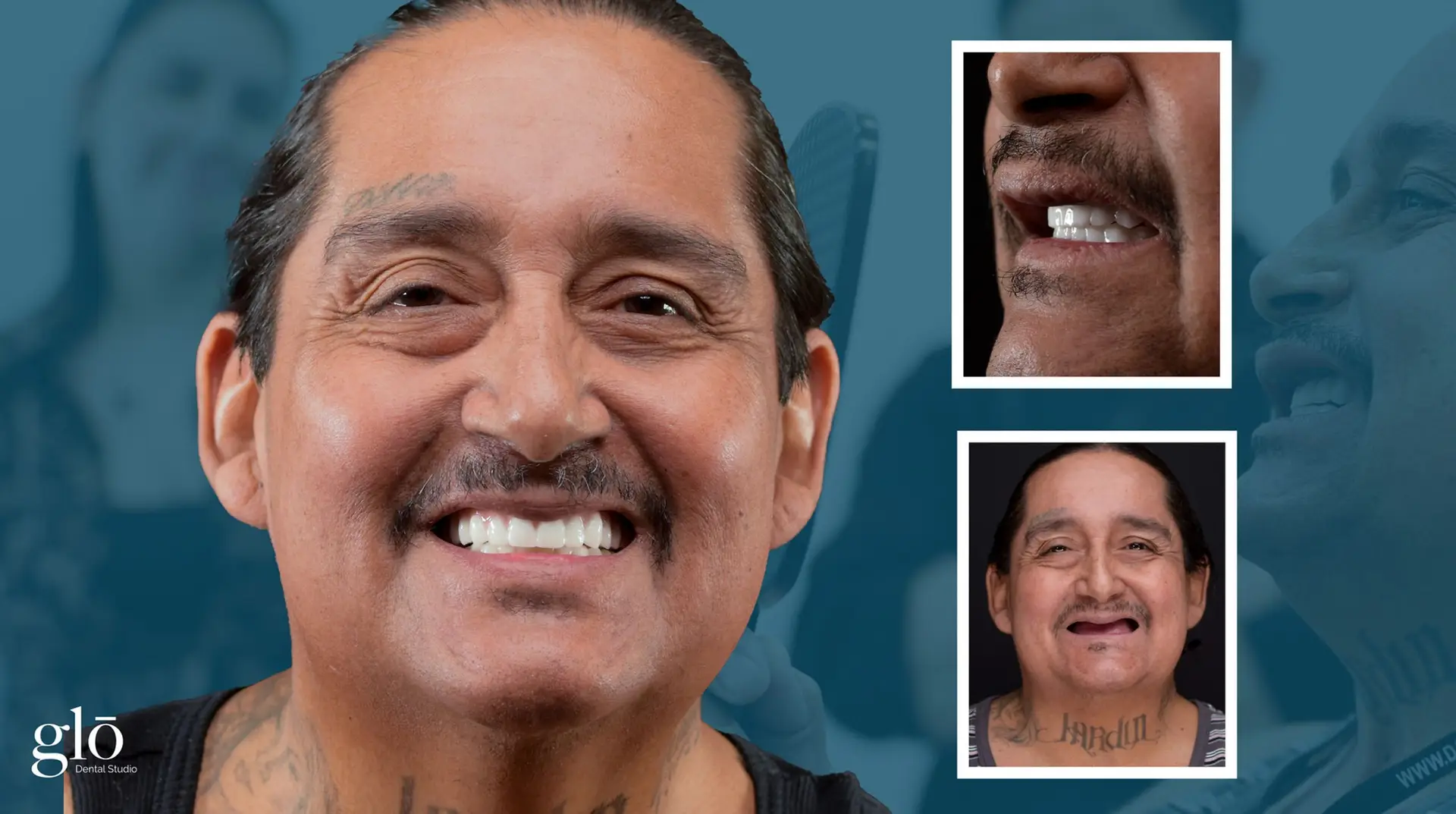 All-on-4 before and after case three