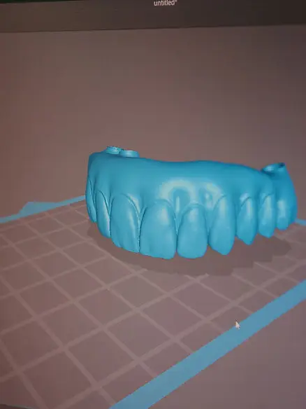 3D digital model of an upper arch of teeth on screen