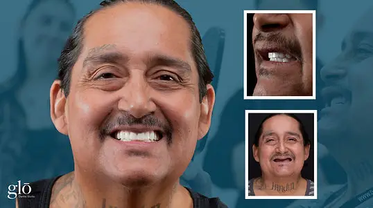 All-on-4 patient with before and after insets