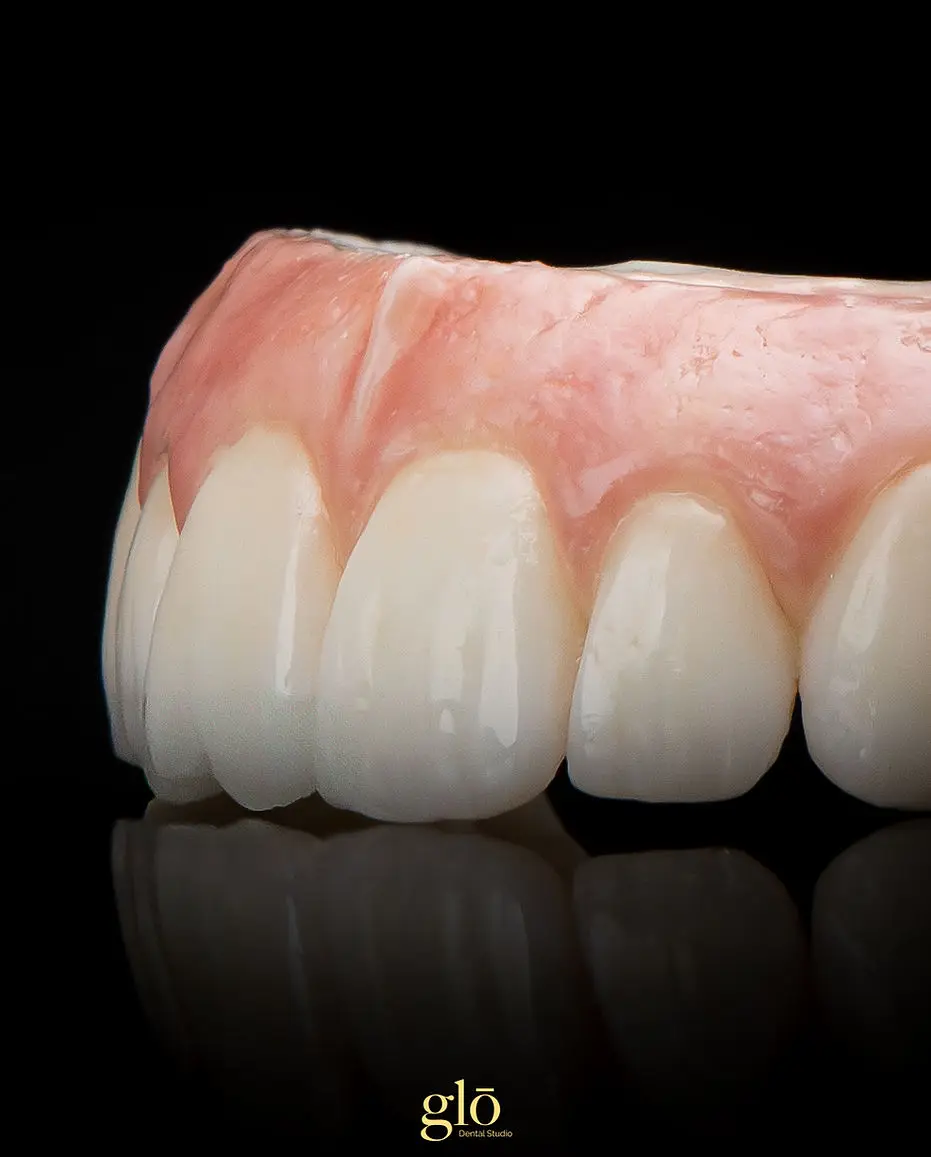 A full-arch zirconia implant bridge