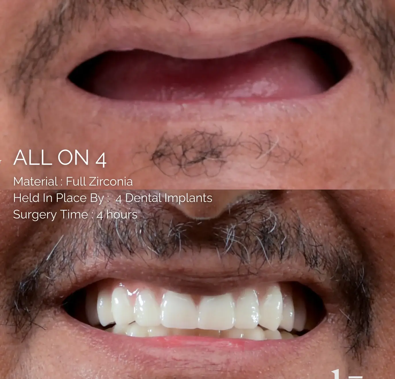 All-on-4 case, before and after: full zirconia bridge held by 4 dental implants, 4-hour surgery