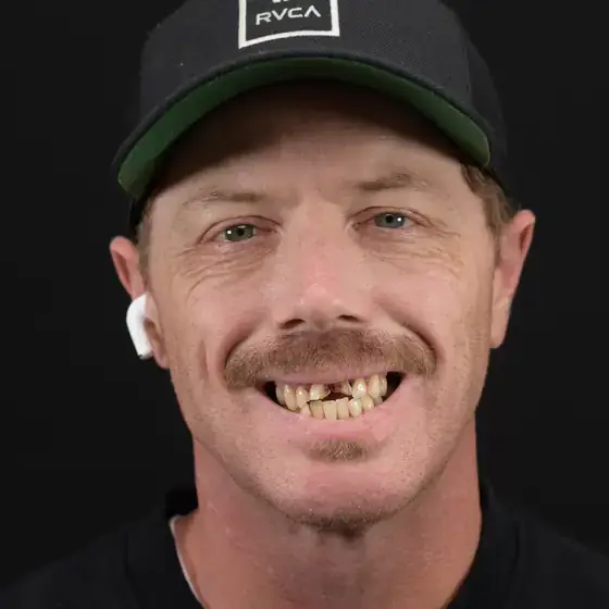 Patient with broken front teeth before treatment