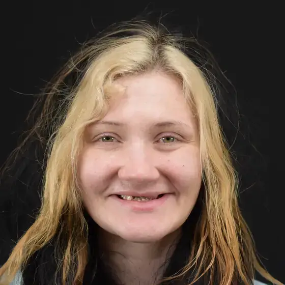 Patient before smile makeover at Glo Dental Studio