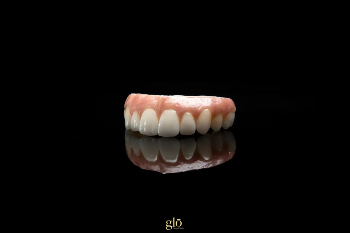 Upper All-on-X customized to each patient's smile and cosmetic preference.