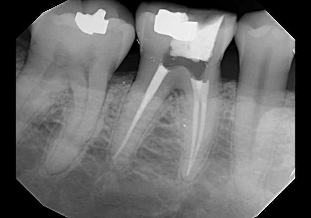 Dental X-ray showing a completed root canal filling in a molar