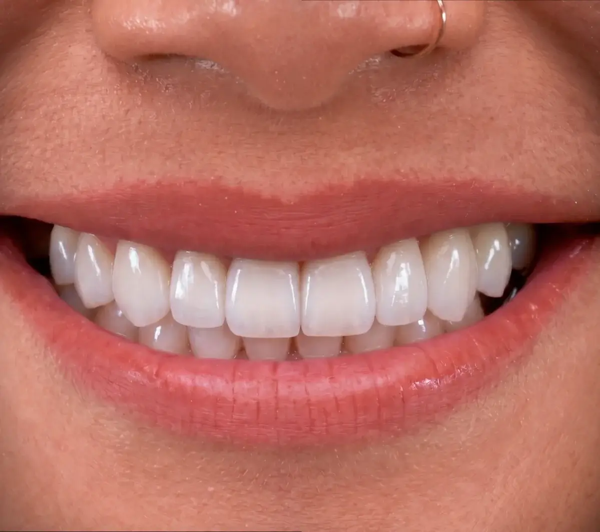 After porcelain veneers: a Glō Dental Studio patient's smile with bright, evenly shaped upper teeth