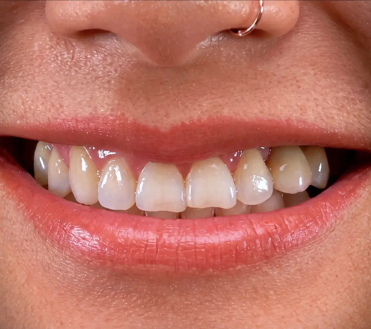 Before porcelain veneers: the same smile with uneven, discolored upper teeth